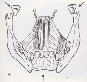 mechanismus odlomení zadních partií čelisti (kresba autora)